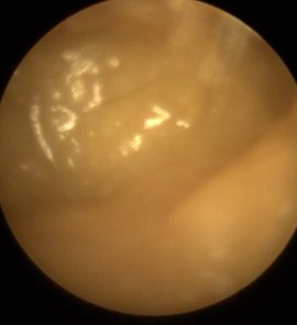 ear wax can be broken down by sodium bicarbonate eardrops