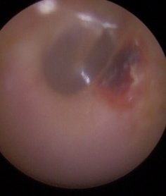 ear canal damaged by a cotton bud
